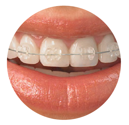 Clear Braces for Adults in Erie, PA - Murray & Iszkula Orthodontics