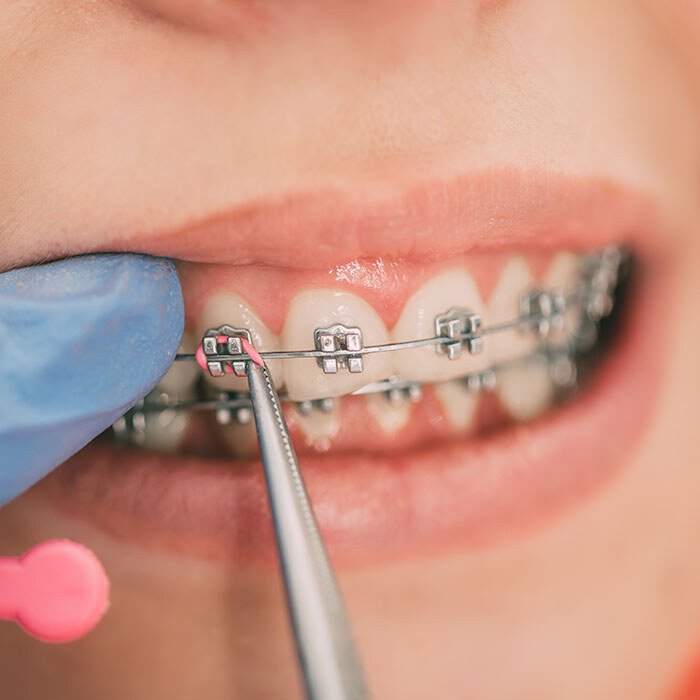 How Do Braces Straighten Teeth?
