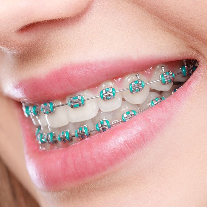 Let's Debunk the Top Braces Excuses